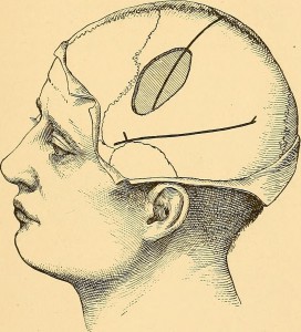 Image from page 60 of "Brain surgery" (1893)